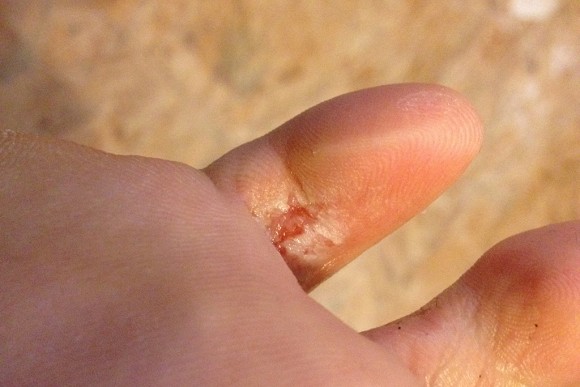 Mycose entre les orteils avant soins.