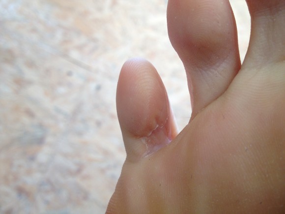 Mycose après une semaine de soins avec de l'huile essentielle de lavande.